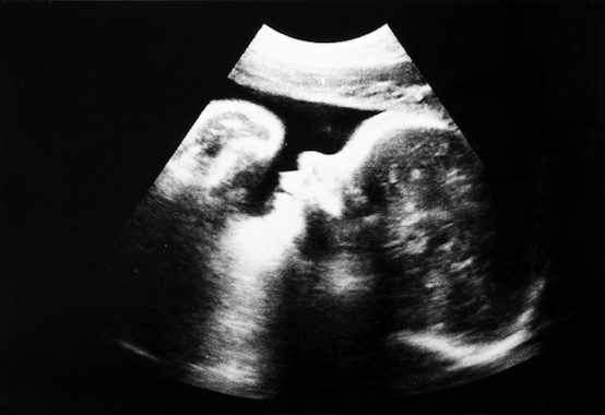 ultrasound 7 month