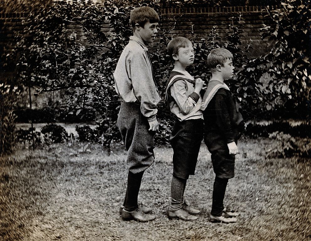 Three_boys_with_Down's_syndrome,_standing_in_a_line._Photogr_Wellcome_V0030054
