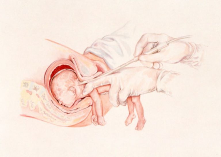 Partial-Birth-Abortion-Diagram-768x546
