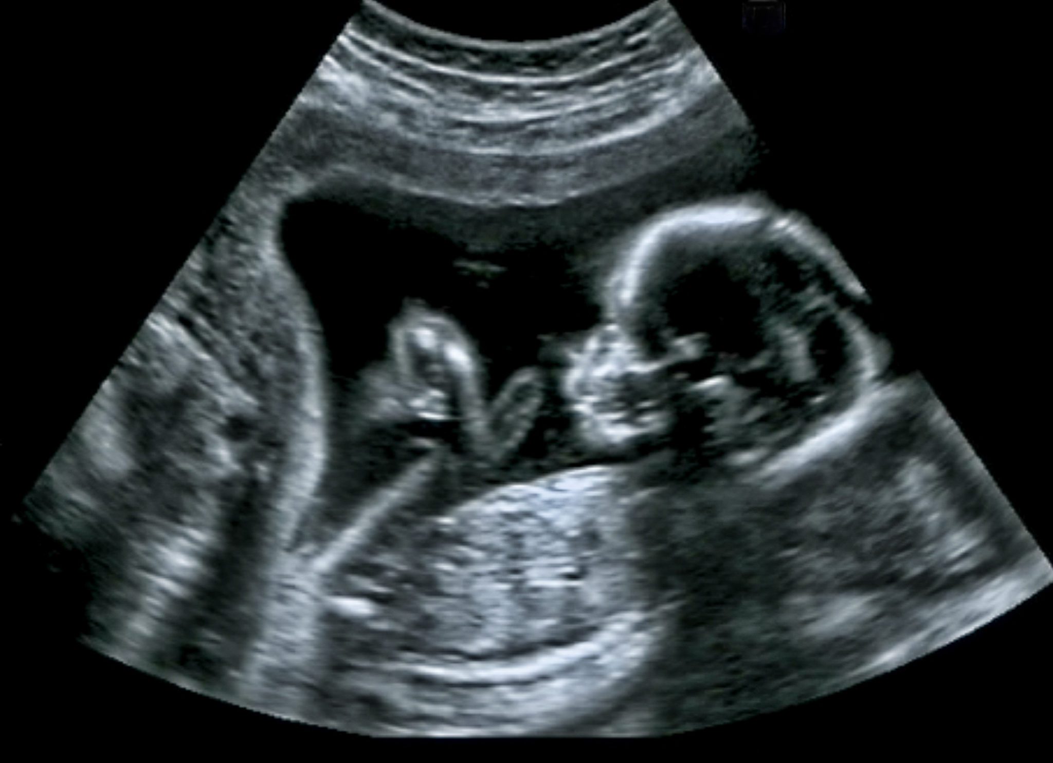 Ultrasound,Of,Baby,In,Mother's,Womb.