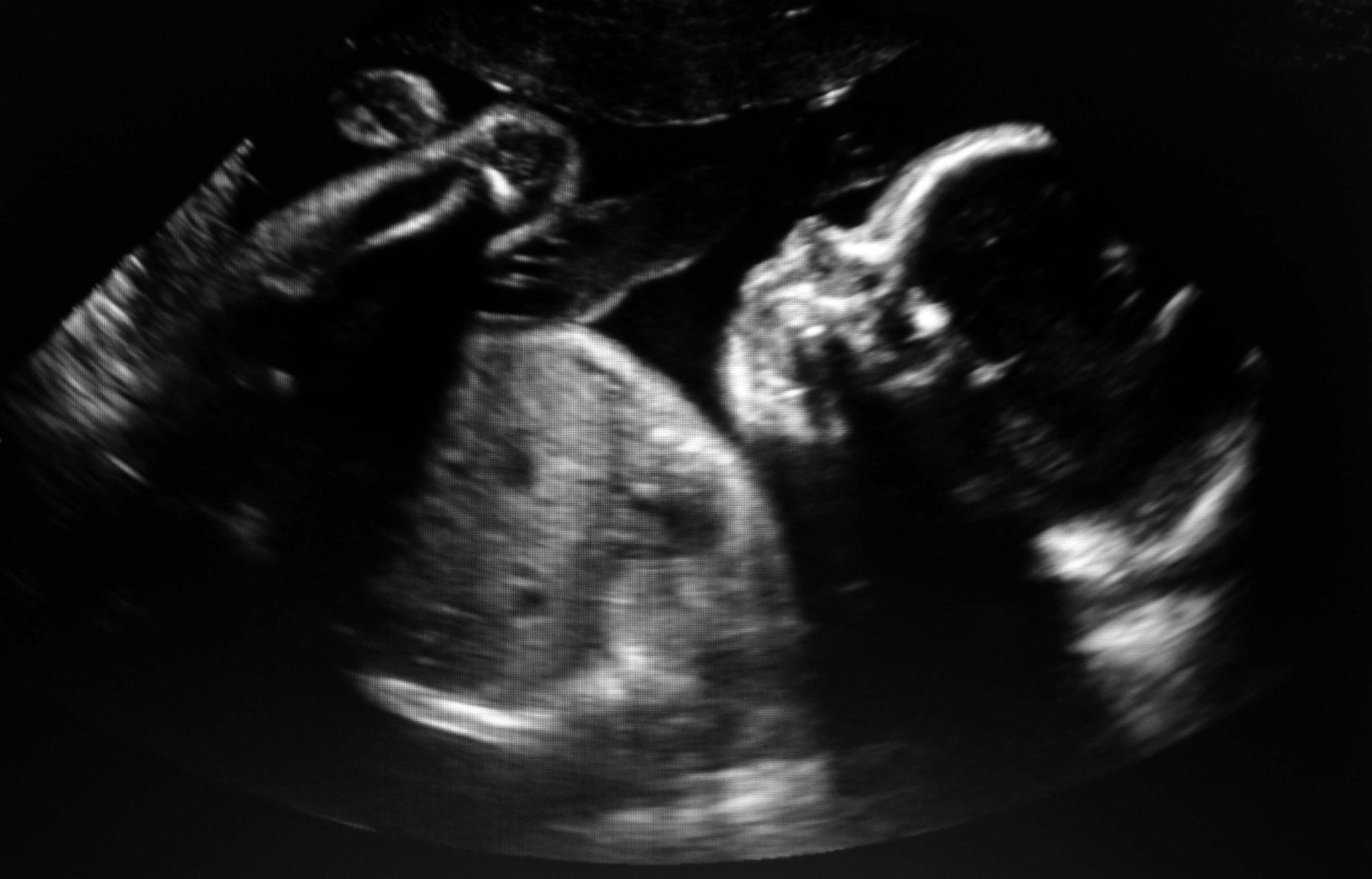 Ultrasound,Baby,In,A,Mother's,Womb.
